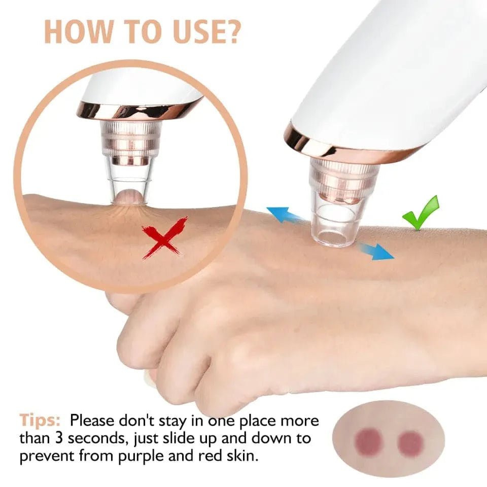 Electric Blackhead Remover, Vacuum Acne Cleaner Removal DeviceFlexora Gadgets